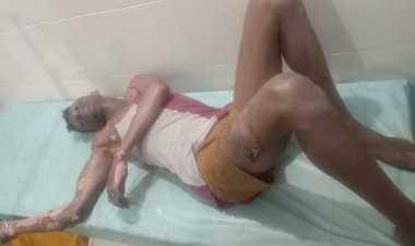 आग में  झुलसे दम्पत्ति